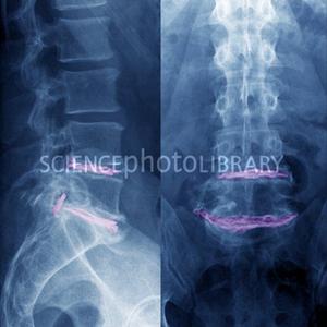 sciatica x rays