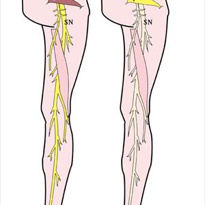 Back Sciatica Group - Sciatica - The Cause And The Cure