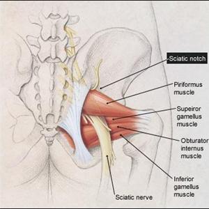 Sciatica Running Injury - Sciatica Exercises - The Good And The Bad