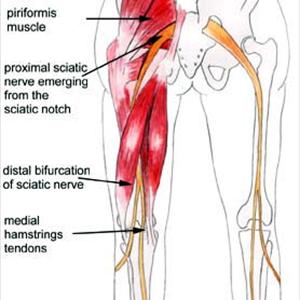 Sciatic Neuralgia Icd 9 - How Can Magnetic Therapy Relieve Sciatica?