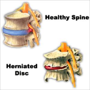 Symptoms Of Sciatica Nerve Damage - Sciatica Or Piriformis Syndrome - Which Is It?