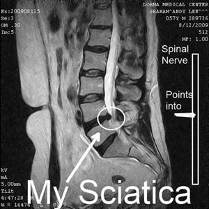Reflexology Sciatica - Relief From Sciatica Back Pain