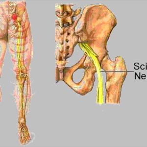 Reflexology Sciatica - Relief From Sciatica Back Pain